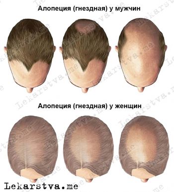 Алопеция (гнездная) Алопеция гнездная фото